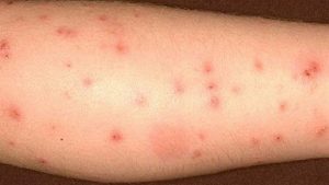 Photo of Bed Bug Bites | Best Home Gear
