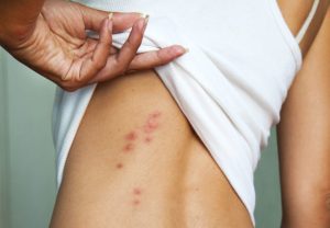 Bed Bug Bites on Torso | Best Home Gear